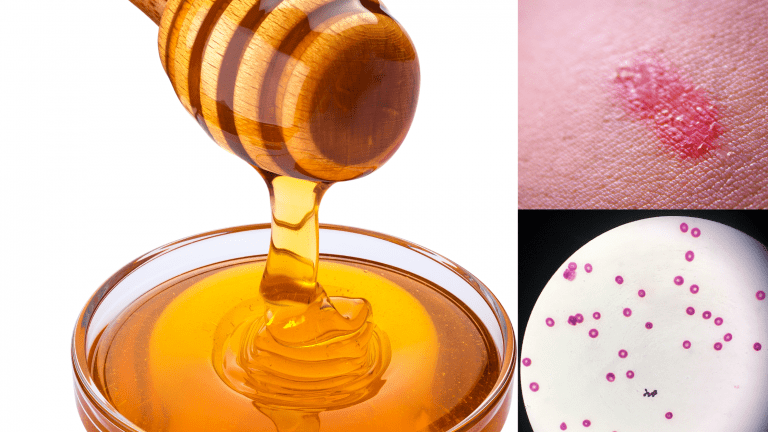 honey for yeast infection